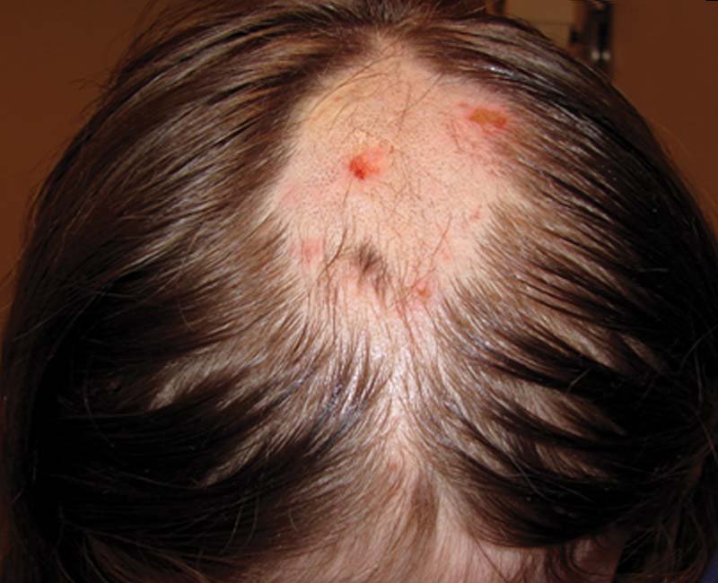 Scalp Psoriasis Treatment in Bhopal showing red, scaly patches on the scalp treated by Dr. Prerna Sharma, Dermatologist and Hair Specialist in Bhopal.