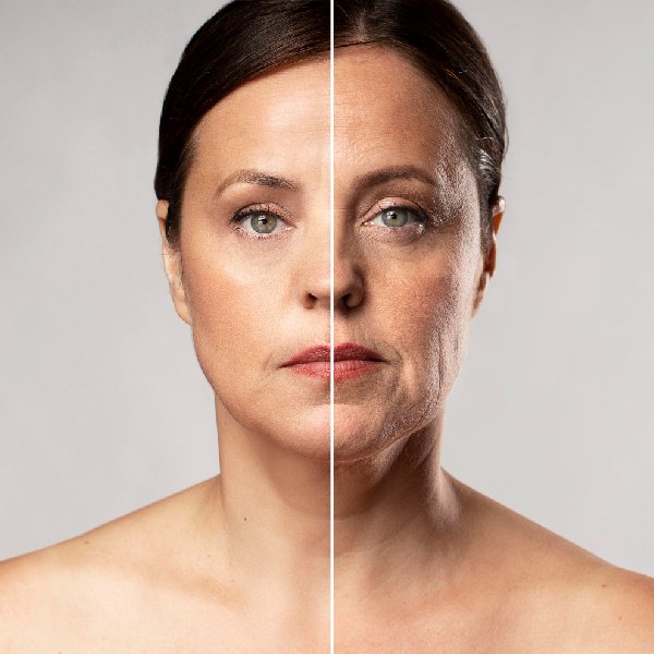 Before and after Anti-Aging Treatment in Bhopal showing reduced wrinkles, improved skin firmness, and facial rejuvenation by Dr. Prerna Sharma, Dermatologist and Skin Specialist in Bhopal.