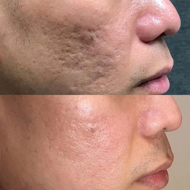 Before and after Acne Scar Treatment in Bhopal showing reduced acne scars and smoother skin by Dr. Prerna Sharma, Dermatologist in Bhopal.