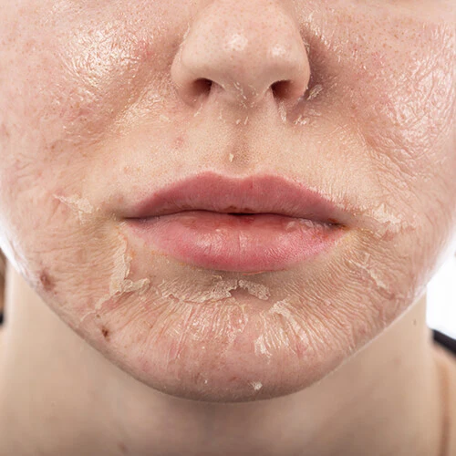 Chemical Peel Treatment in Bhopal showing post-treatment skin peeling for acne scars, pigmentation, and skin rejuvenation by Dr. Prerna Sharma, Dermatologist in Bhopal.