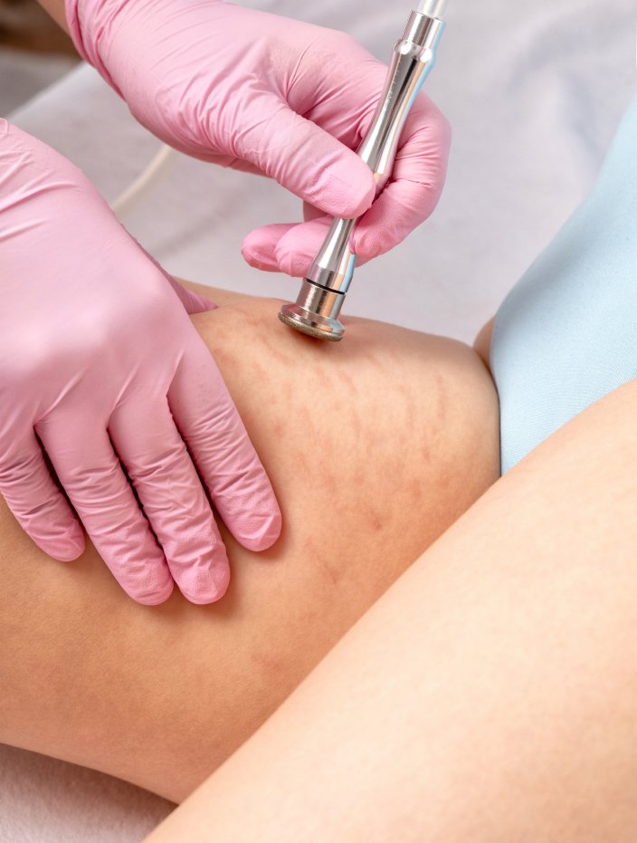 Stretch Marks Treatment in Bhopal using advanced radio frequency skin tightening technology by Dr. Prerna Sharma, Dermatologist and Skin Specialist in Bhopal.