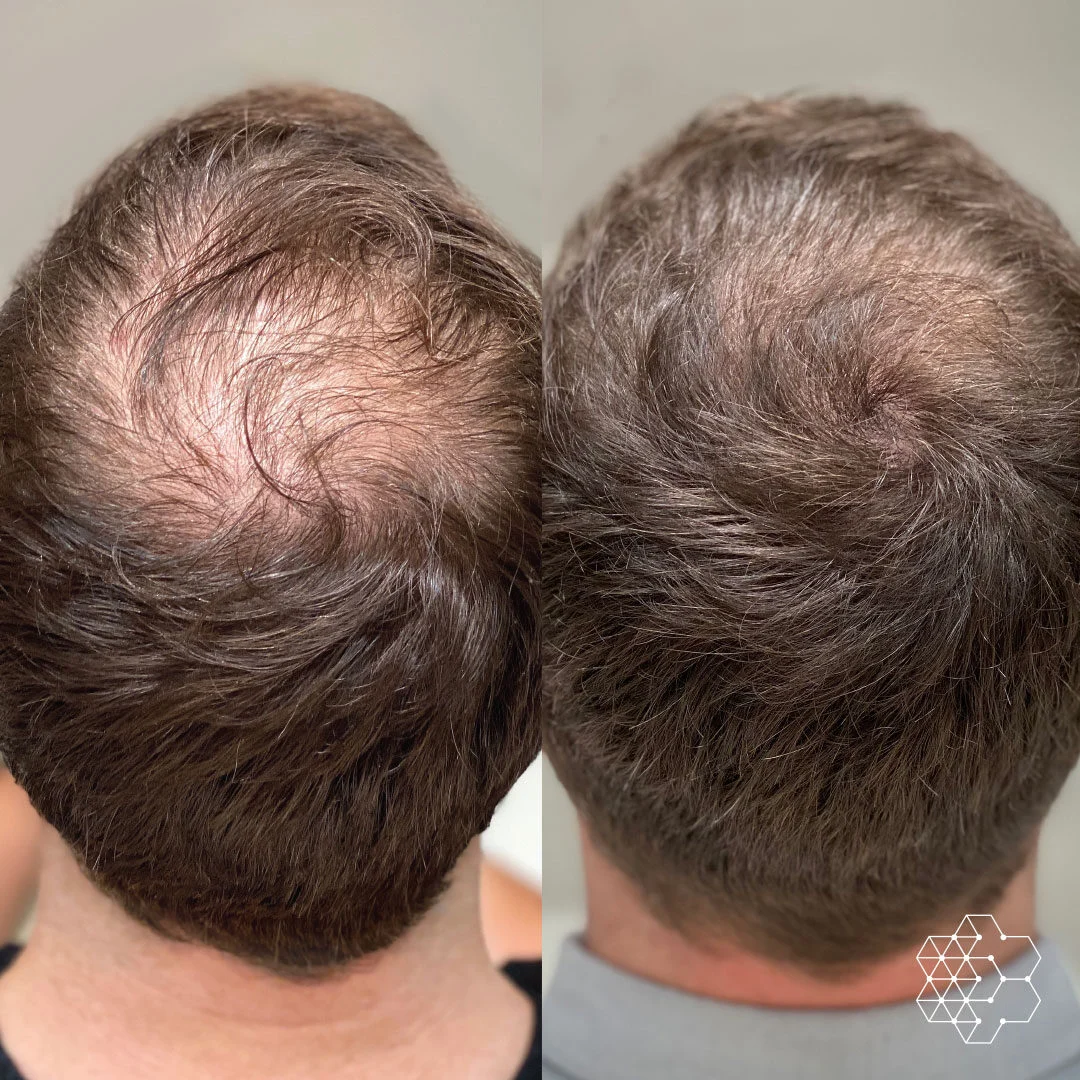 Before and after Hair Loss Treatment in Bhopal showing improved hair density and hair regrowth by Dr. Prerna Sharma, Dermatologist and Hair Specialist in Bhopal.