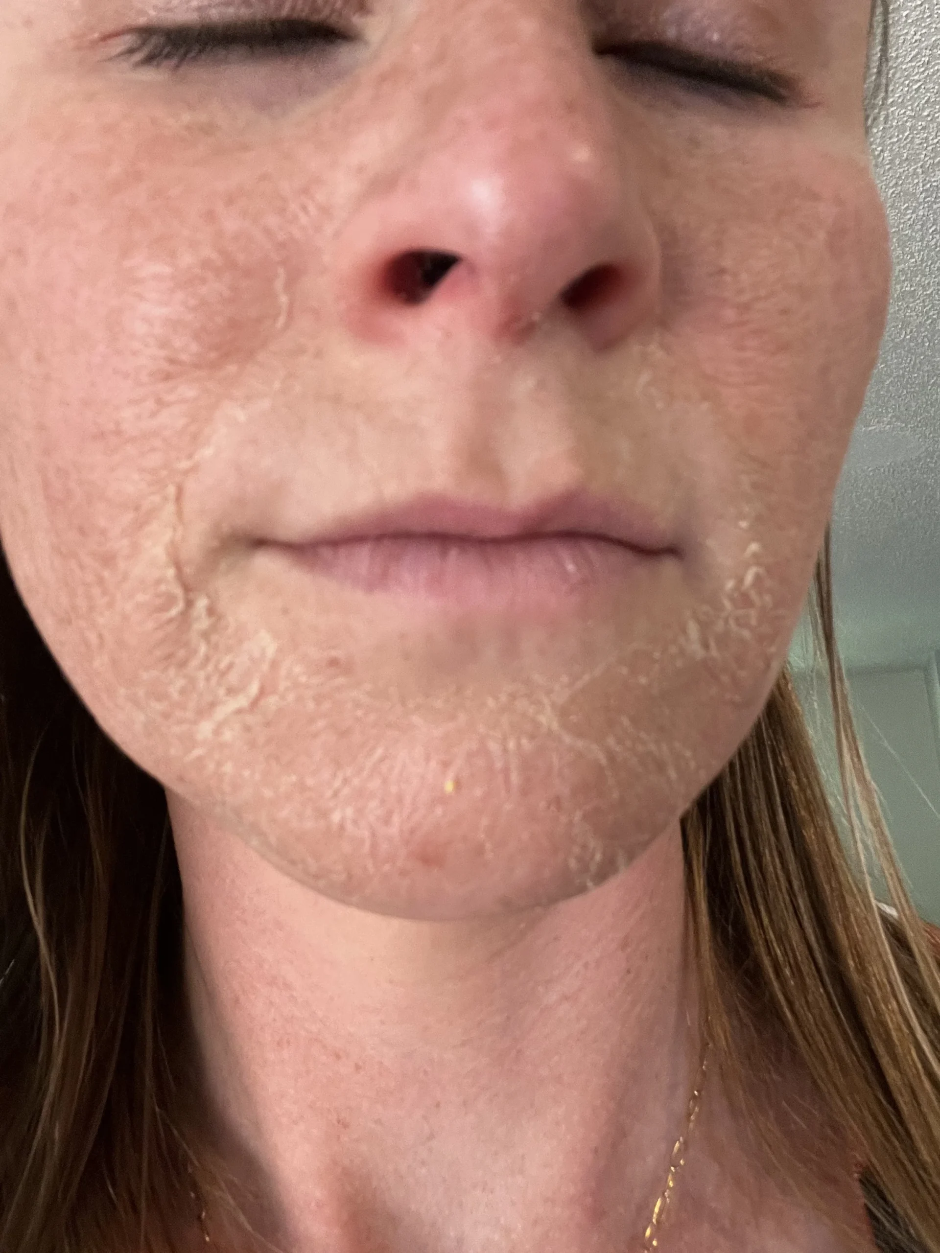 Chemical Peel Treatment in Bhopal showing skin peeling after treatment by Dr. Prerna Sharma, Dermatologist and Skin Specialist in Bhopal.