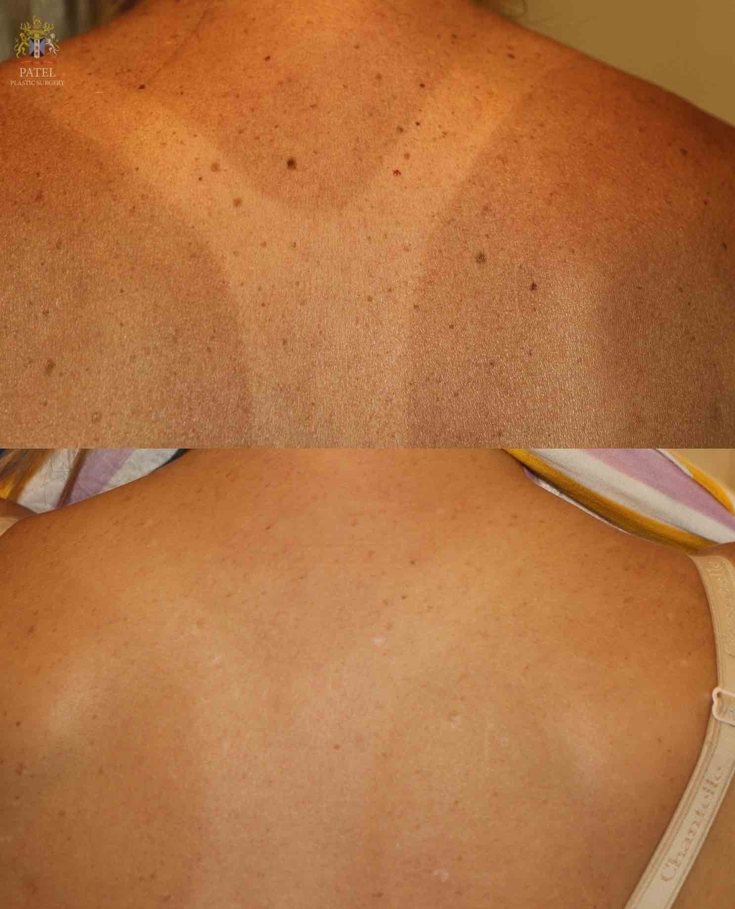 Before and after Mole Removal Treatment in Bhopal showing successful removal of multiple skin moles on the back by Dr. Prerna Sharma, Dermatologist in Bhopal.