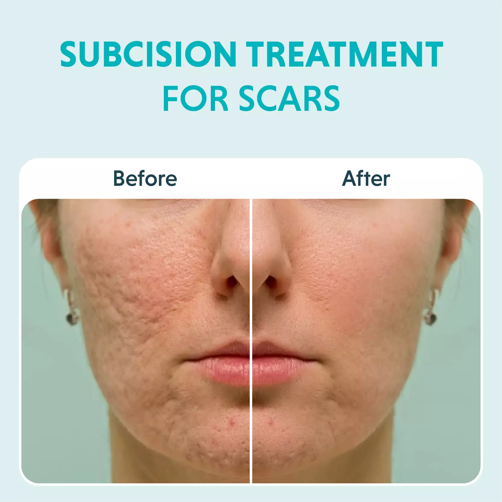 Before and after Subcision Treatment for Acne Scars in Bhopal showing visible improvement in acne scars by Dr. Prerna Sharma, Dermatologist in Bhopal.