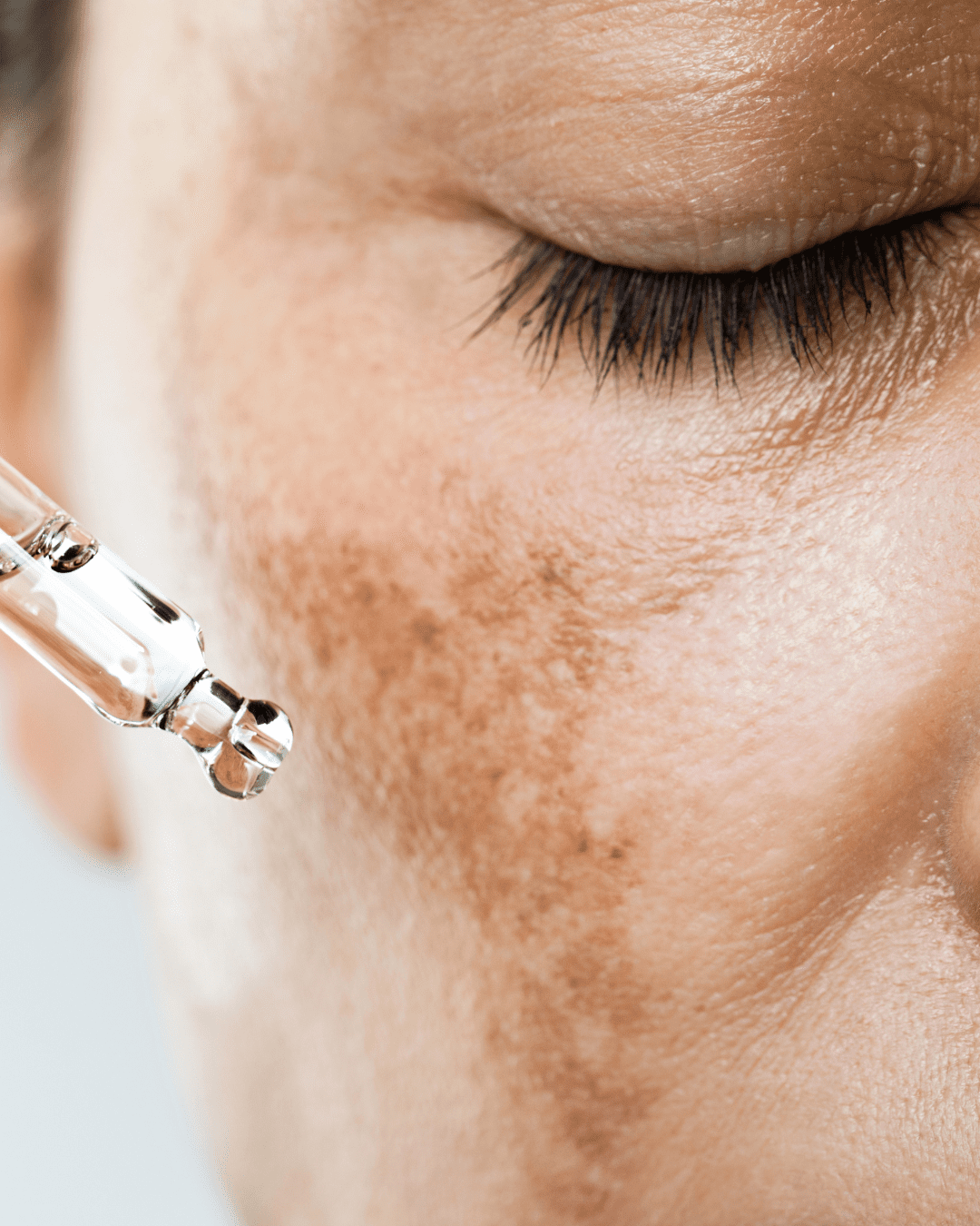 Melasma Treatment in Bhopal for facial pigmentation and dark patches by Dr. Prerna Sharma, Dermatologist and Skin Specialist in Bhopal.