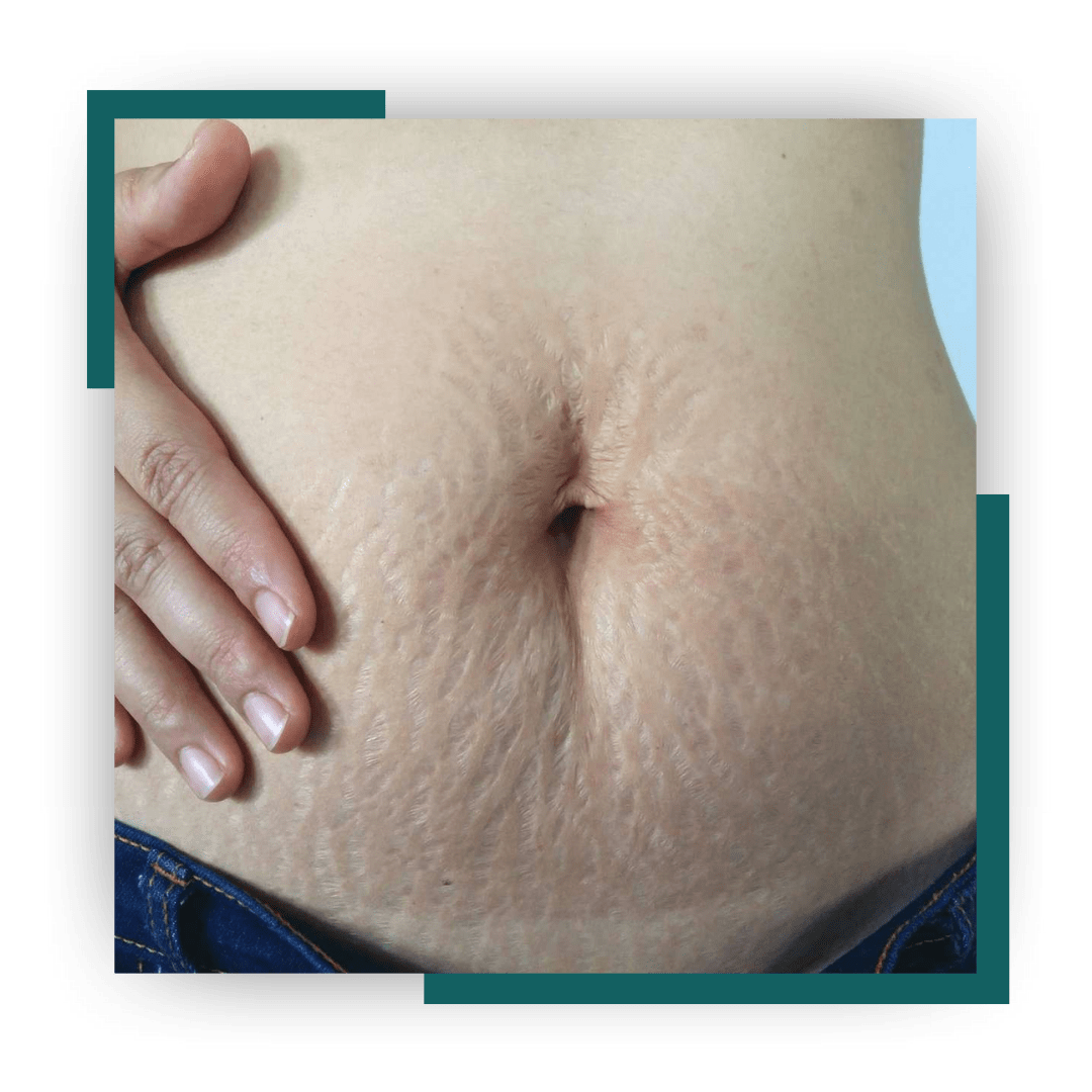 Stretch Marks Removal Treatment in Bhopal for abdominal stretch marks by Dr. Prerna Sharma, Dermatologist and Skin Specialist in Bhopal.