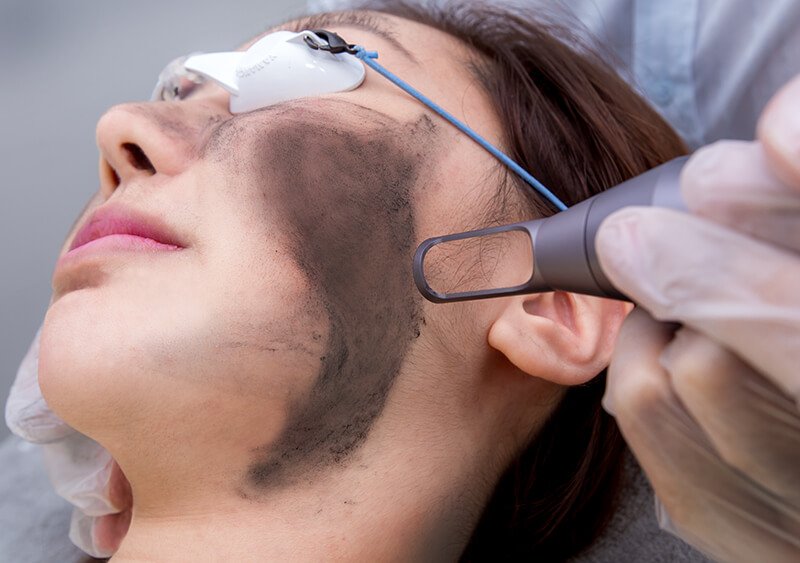 Laser Carbon Peel Treatment in Bhopal performed by Dr. Prerna Sharma, Dermatologist in Bhopal, for skin brightening, acne control, deep cleansing, and pigmentation reduction.