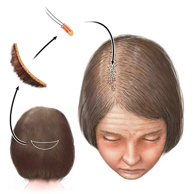Hair Transplant Treatment in Bhopal illustration showing follicular unit transplantation (FUT/FUE) for natural hair restoration by Dr. Prerna Sharma, Dermatologist and Hair Specialist in Bhopal.