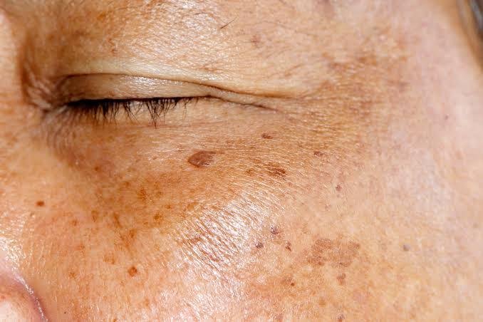 Pigmentation Treatment in Bhopal for age spots, sun spots, and facial hyperpigmentation by Dr. Prerna Sharma, Dermatologist and Skin Specialist in Bhopal.