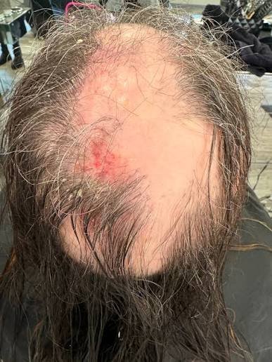 Alopecia Areata Treatment in Bhopal showing patchy hair loss on the scalp treated by Dr. Prerna Sharma, Dermatologist and Hair Specialist in Bhopal.
