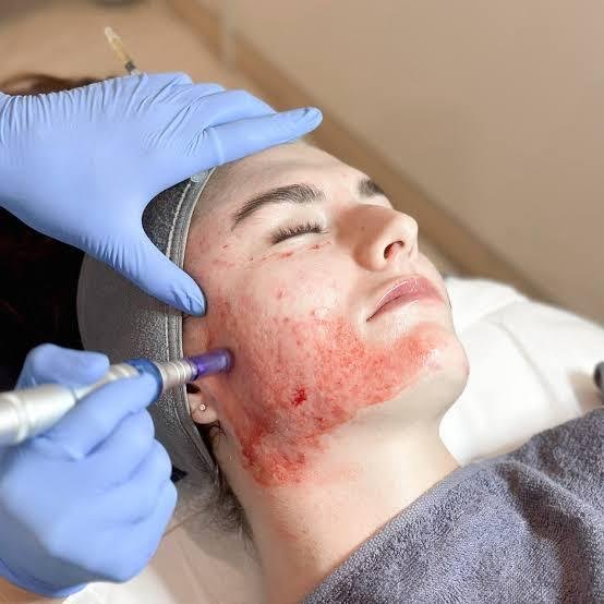 Microneedling RF Treatment for Acne Scars in Bhopal performed by Dr. Prerna Sharma, Dermatologist in Bhopal, to improve acne scars and skin texture.