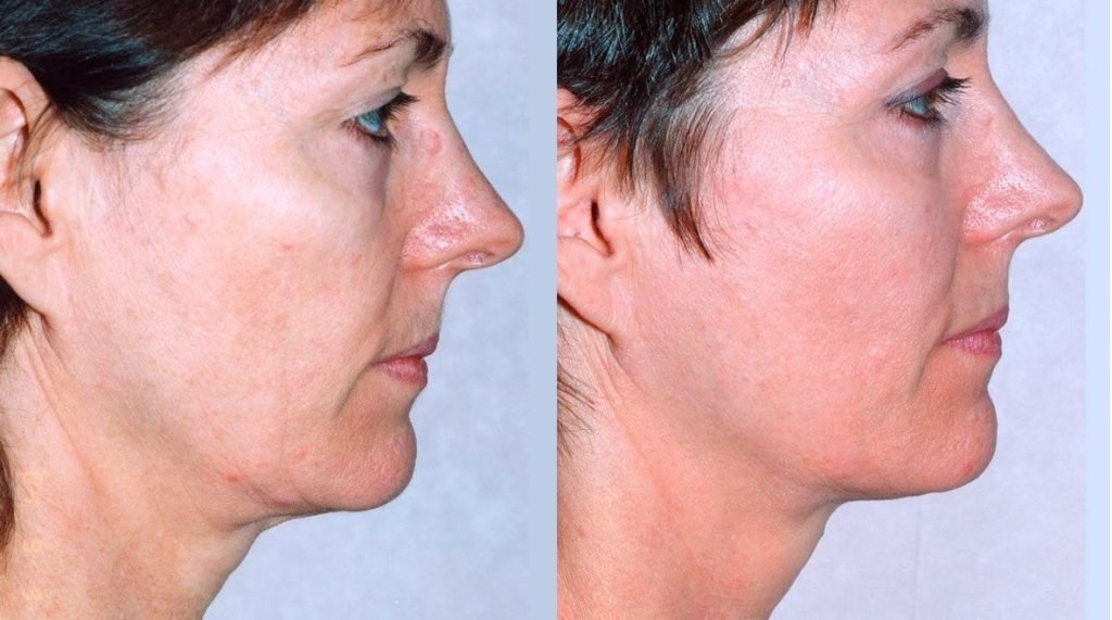 Before and after Anti-Aging Treatment in Bhopal showing improvement in wrinkles, fine lines, and skin tightening by Dr. Prerna Sharma, Dermatologist in Bhopal.