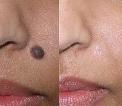 Before and after Mole Removal Treatment in Bhopal showing safe removal of a facial mole by Dr. Prerna Sharma, Dermatologist and Skin Specialist in Bhopal.