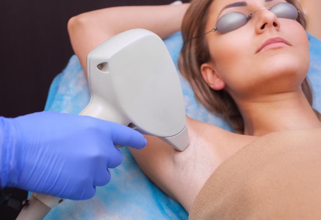 Laser Hair Removal Treatment in Bhopal being performed on the underarm using advanced laser technology by Dr. Prerna Sharma, Dermatologist and Skin Specialist in Bhopal.